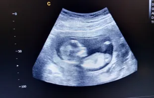 Ultrasound scan of 15 week-old baby. Credit: Allo4e4ka/Shutterstock